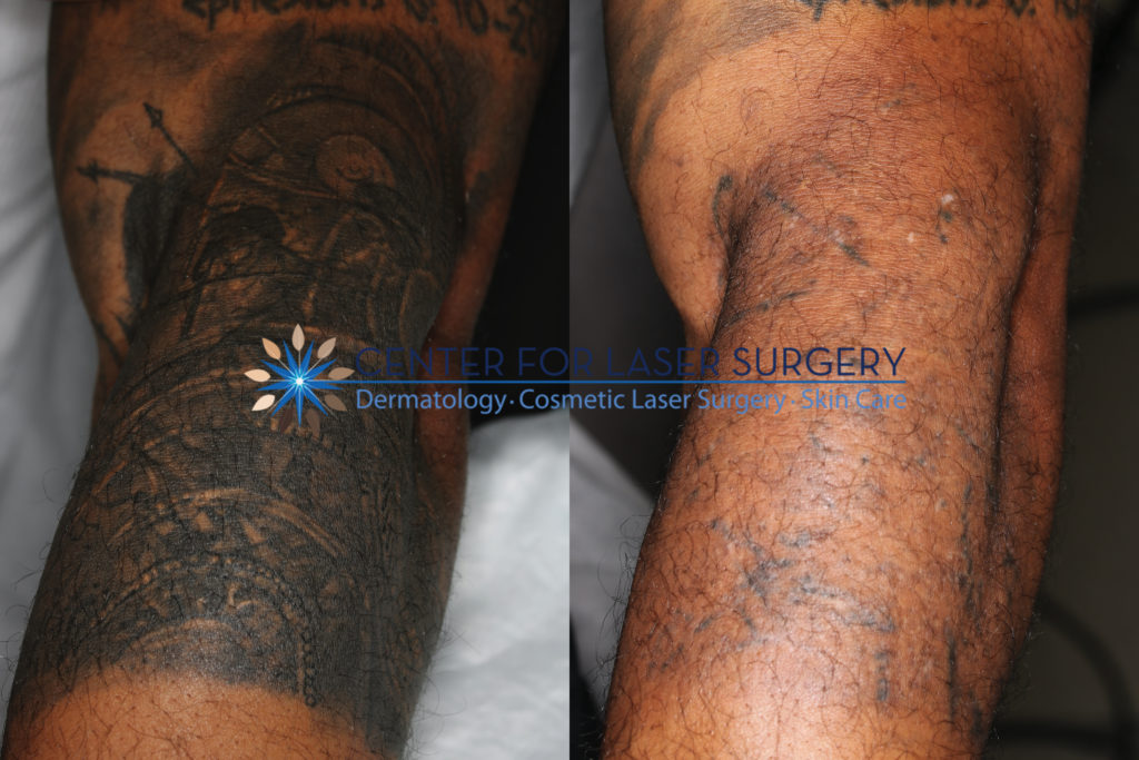 Expert Tattoo Removal Washington Dc Center For Laser Surgery Expert Tattoo Removal Washington Dc Center For Laser Surgery