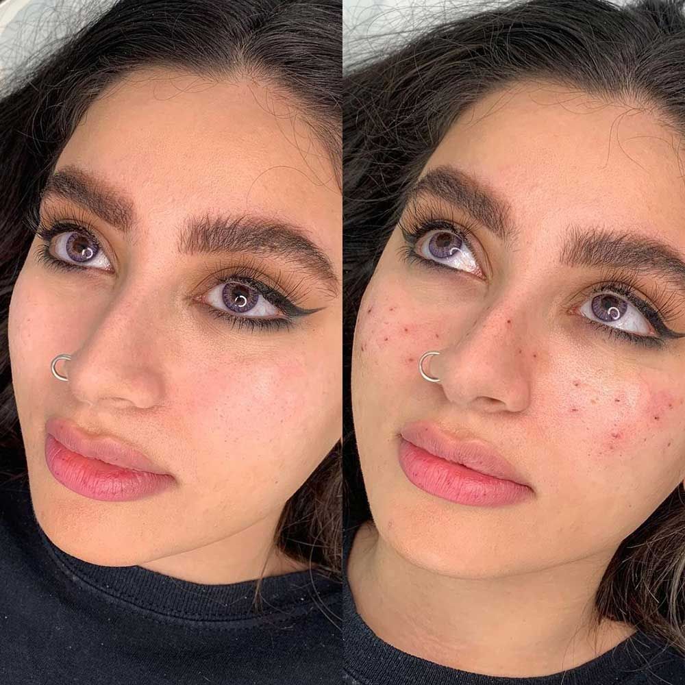 Freckle Tattoos Before And After Pictures Gallery Best Examples Freckle Tattoos Before And After Pictures Gallery Best Examples