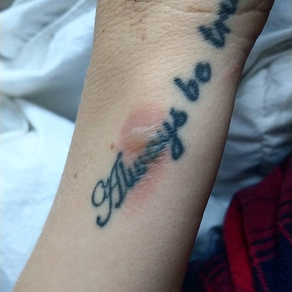 Tattoo Mri Burn Tattoo Mri Burn