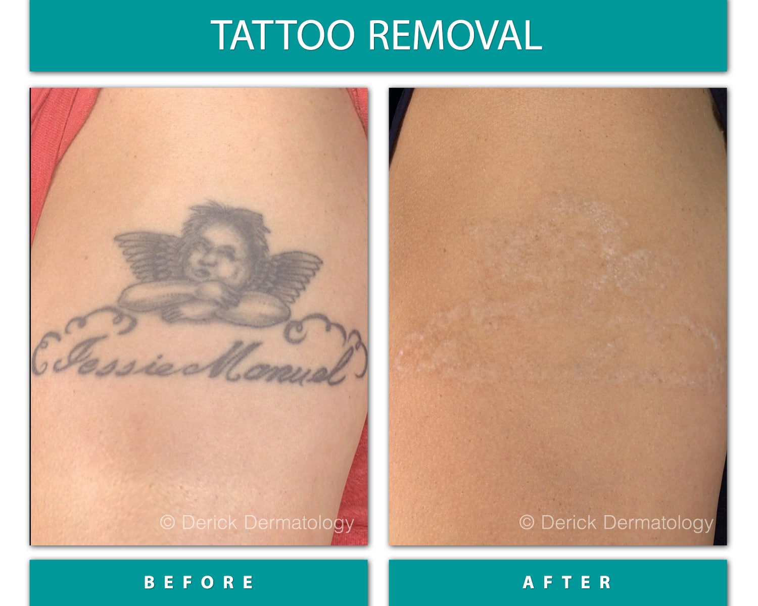 Types Of Tattoo Removal How Tattoo Removal Lasers Work Dermatology Types Of Tattoo Removal How Tattoo Removal Lasers Work Dermatology
